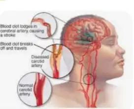 Terapi stroke bisa datang ke alamat pasien