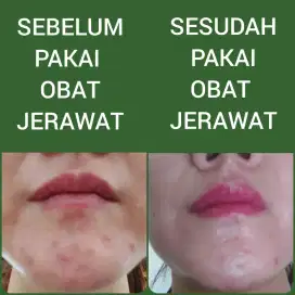 CREAM JERAWAT DI WAJAH DAN OBAT MINUM DI SURABAYA