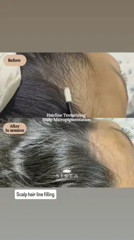 DICARI MODEL. Kepala TIPIS PITAK SULAM RAMBUT HAIR MICROPIGMENTATIOM