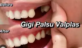 Pasang gigi palsu