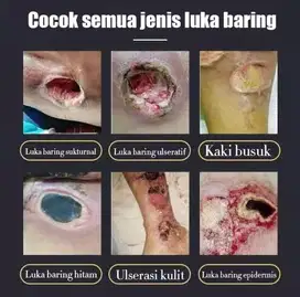 Salep luka baring