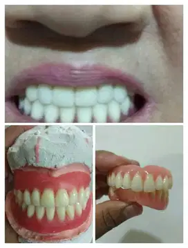 Dental gigi,,bisa lepasan atau pasang permanen.