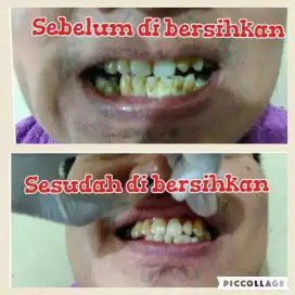 Karang gigi bisa bersih langsung di jamin