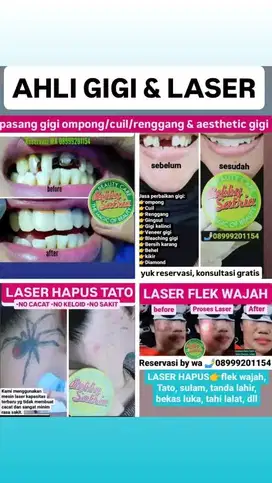 laser hapus tato dan pasang gigi