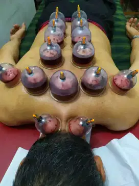 Bersertifikat resmi jasa  bekam panggilan home care