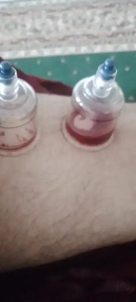 Bekam sunnah siap datang kerumah anda