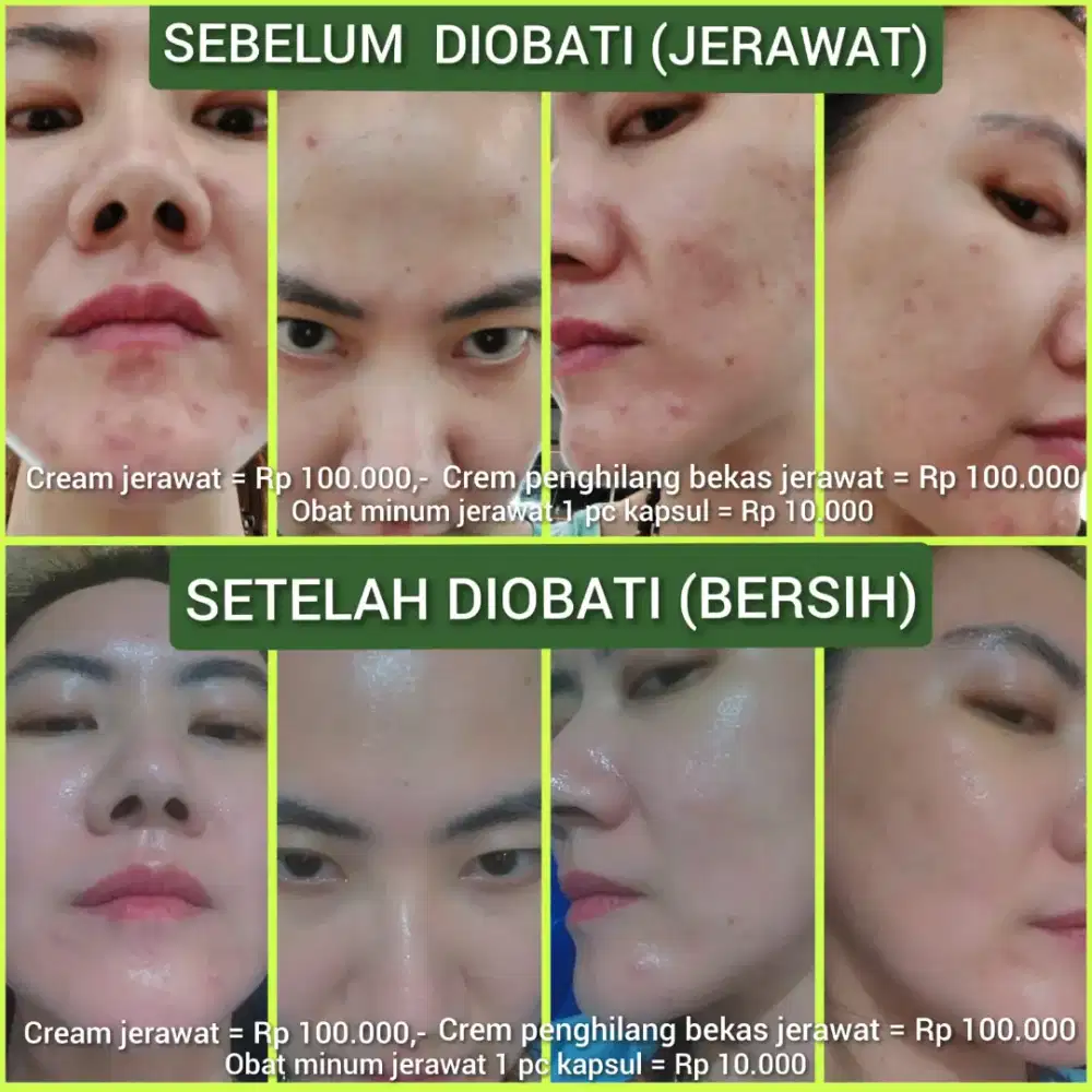 CREAM JERAWAT DI WAJAH DAN OBAT MINUM DI SURABAYA