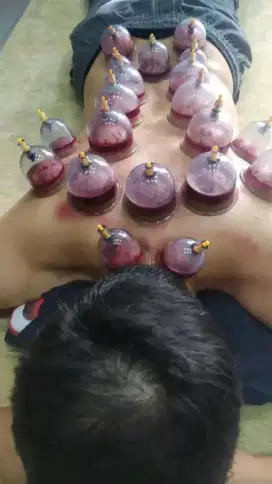 Bekam membuang Racun detoksifikasi
