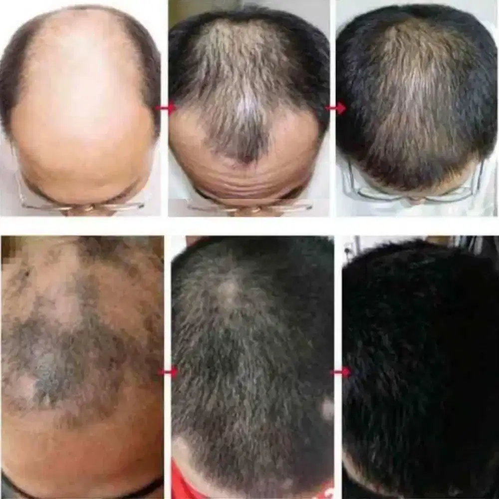 Rambut 100% Lebat. Gratis Ongkir khusus 10 orang pembeli hari ini.
