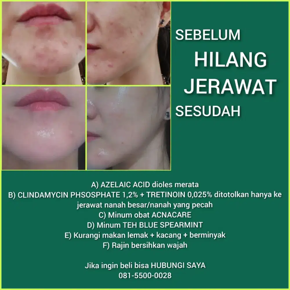 CREAM JERAWAT DI WAJAH DAN OBAT MINUM DI SURABAYA