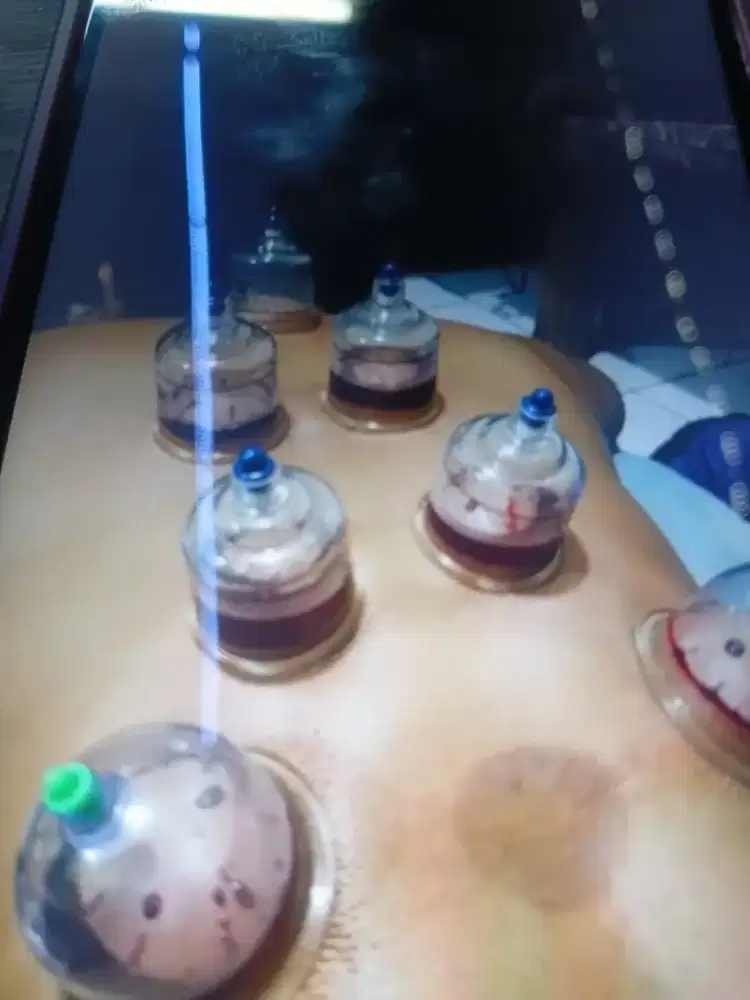 Bekam sunnah kering dan basah