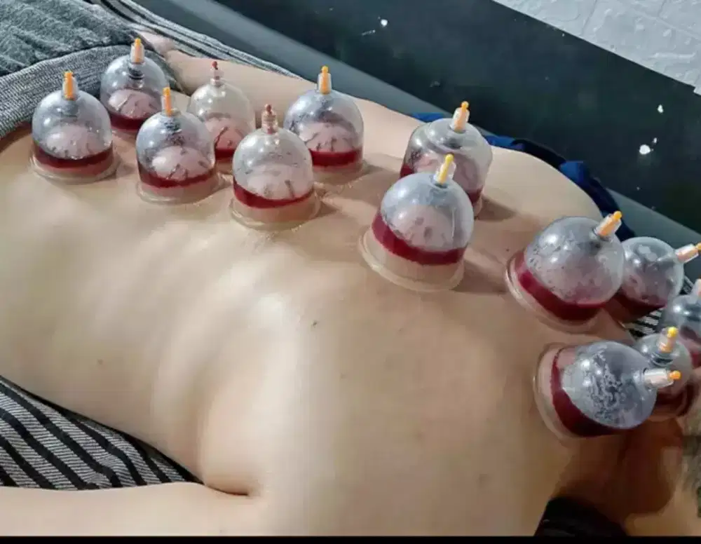 Jasa bekam panggilan untuk pria