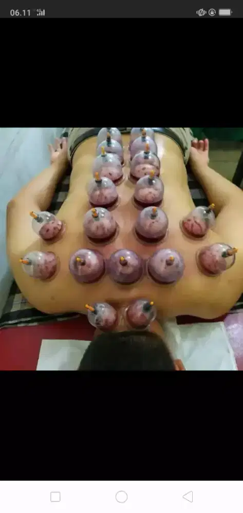 Bekam panggilan (sehat dengan berbekam)