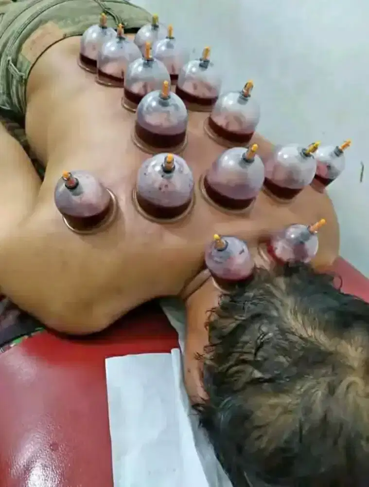 Jasa bekam panggilan untuk kesehatan tubuh