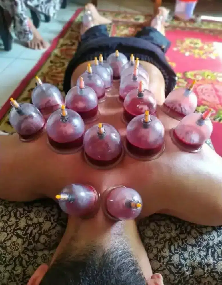 Bekam panggilan (sehat dengan berbekam)