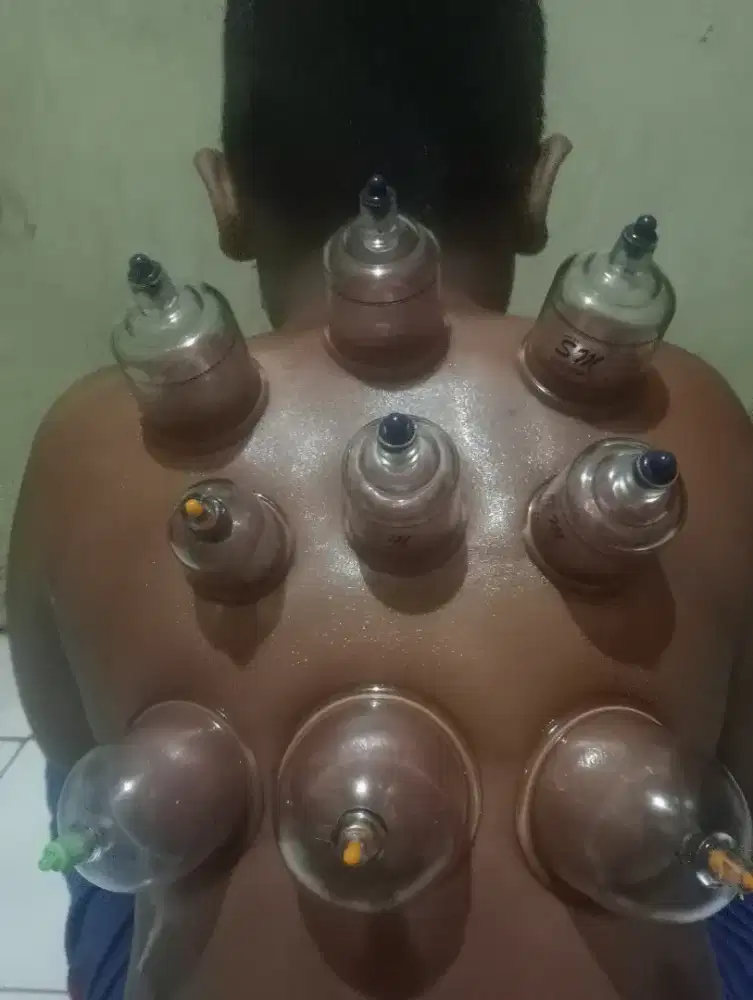 Bekam sunnah siap kerumah anda