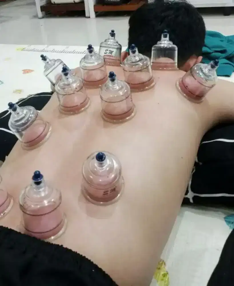 Pelayanan kesehatan terapi bekam