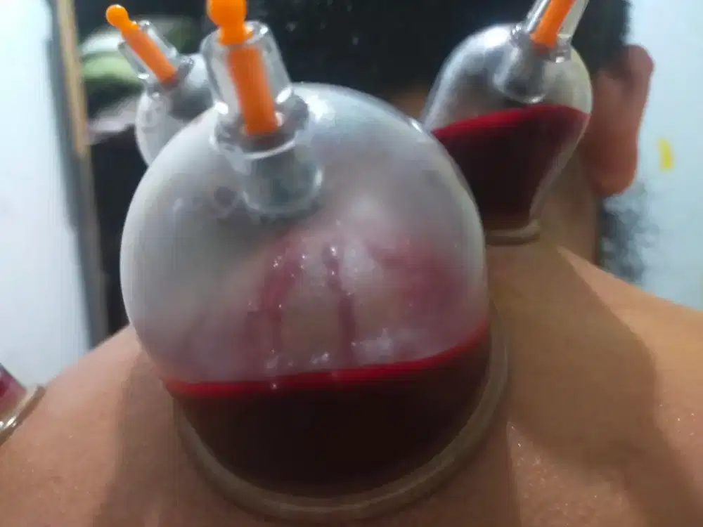 Layanan jasa bekam panggilan