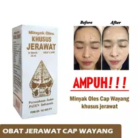 OBAT JERAWAT CAP WAYANG