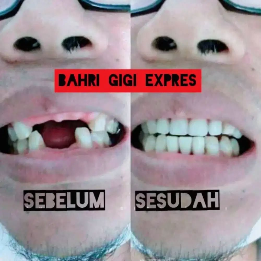 Pasang gigi palsu terjangkau bergaransi