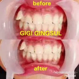 Before gigi gingsul