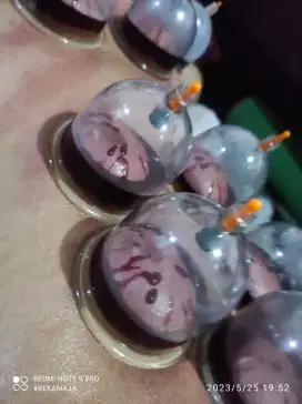 TERAPI BEKAM BASAH SURABAYA AREA & SEKITARNYA