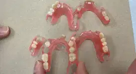 Pasang gigi palsu valplast fleksibel anti pecah tampak natural