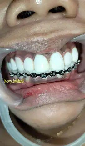 Gigi palsu venner behel dll