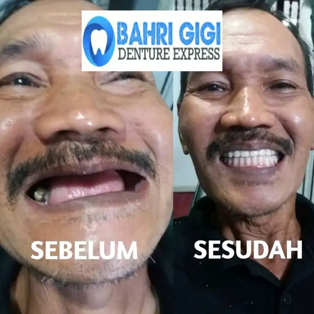 Pasang gigi palsu terjangkau terlaris