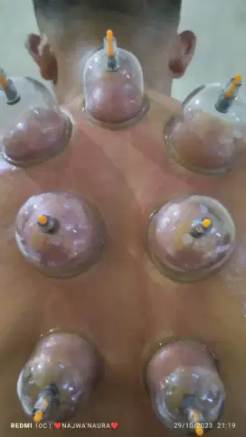 Terapi Bekam panggilan